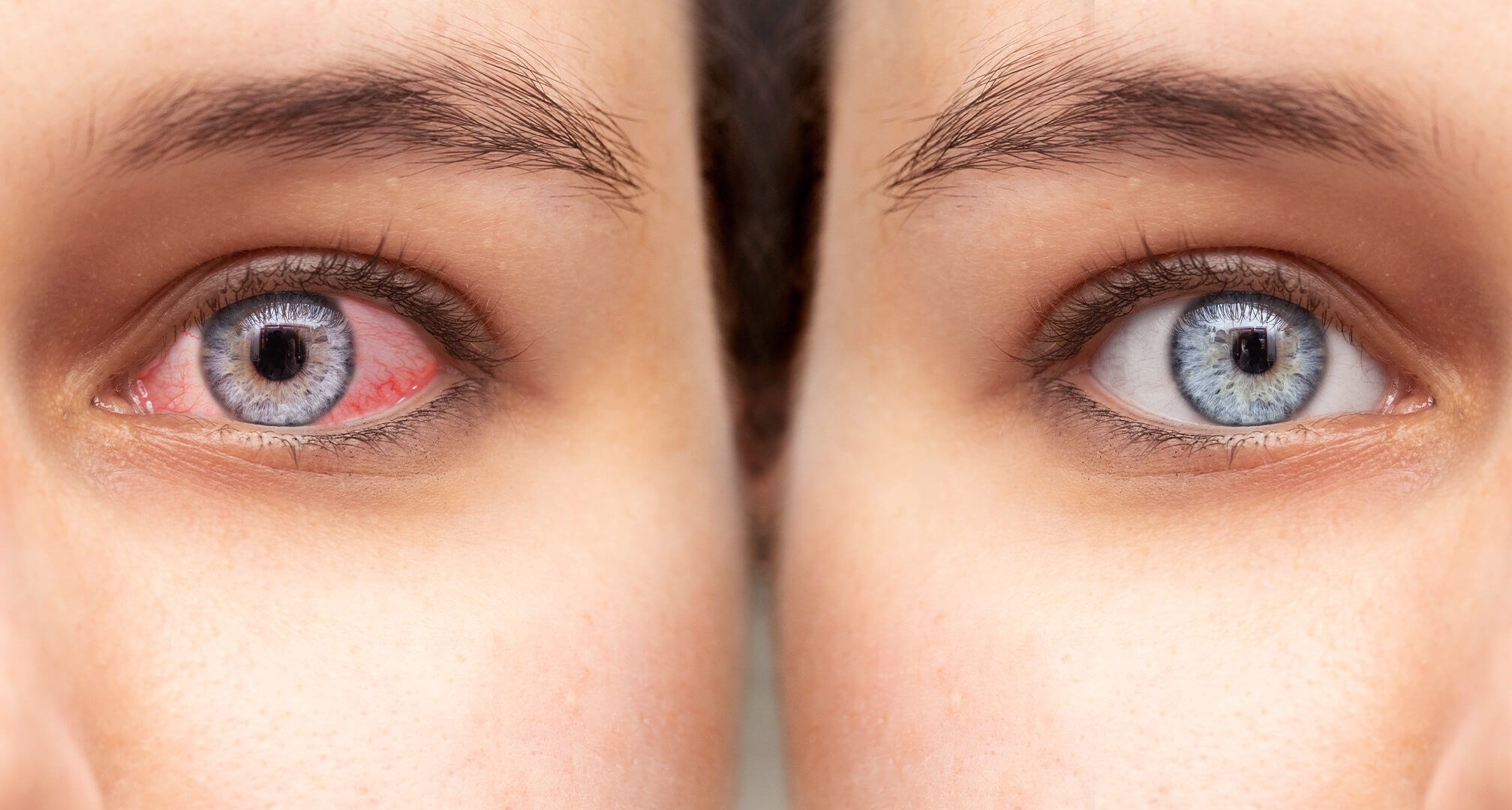 Kontaktlinsen bei trockenen Augen • Kuratorium Gutes Sehen e.V.